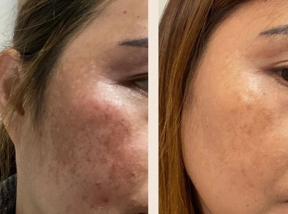 Tranexplus - Single Vial