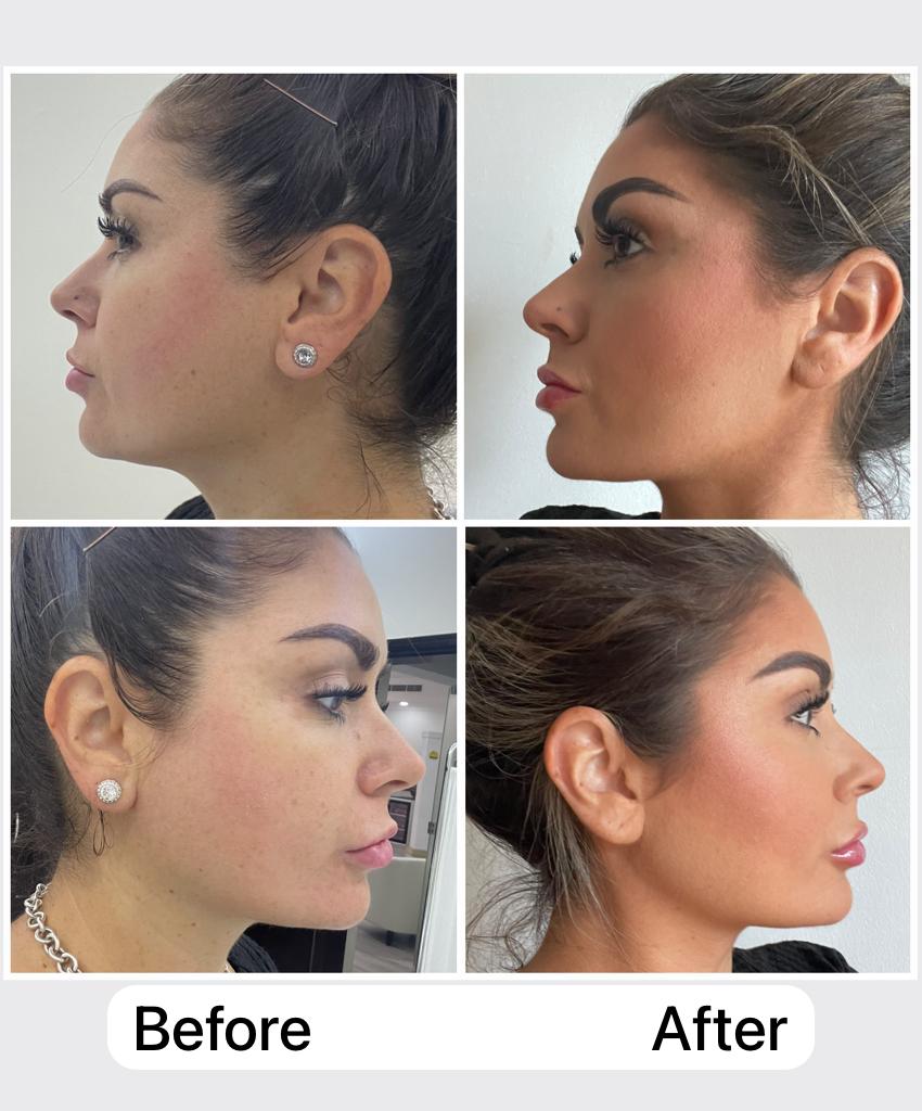 Double chin removal and jawline tightening 